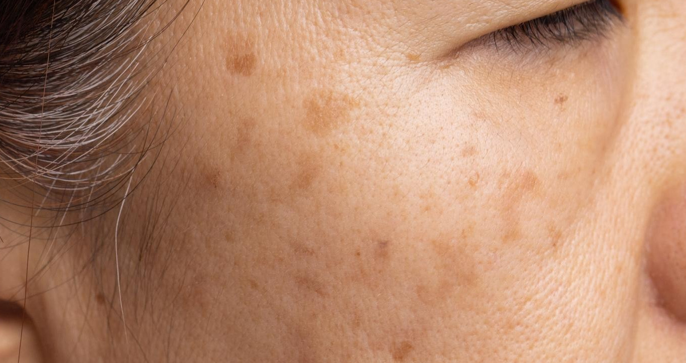 Quais as áreas do corpo mais afetadas pelo melasma?