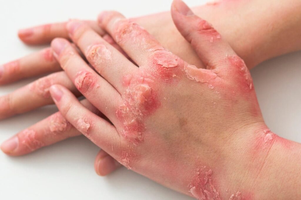Close-up de mãos com lesões e descamações avermelhadas causadas por psoríase, ilustrando os sintomas que exigem diagnóstico e tratamento dermatológico com a Dra. Luciane na Clínica Reviva, no Cambuí, Campinas.